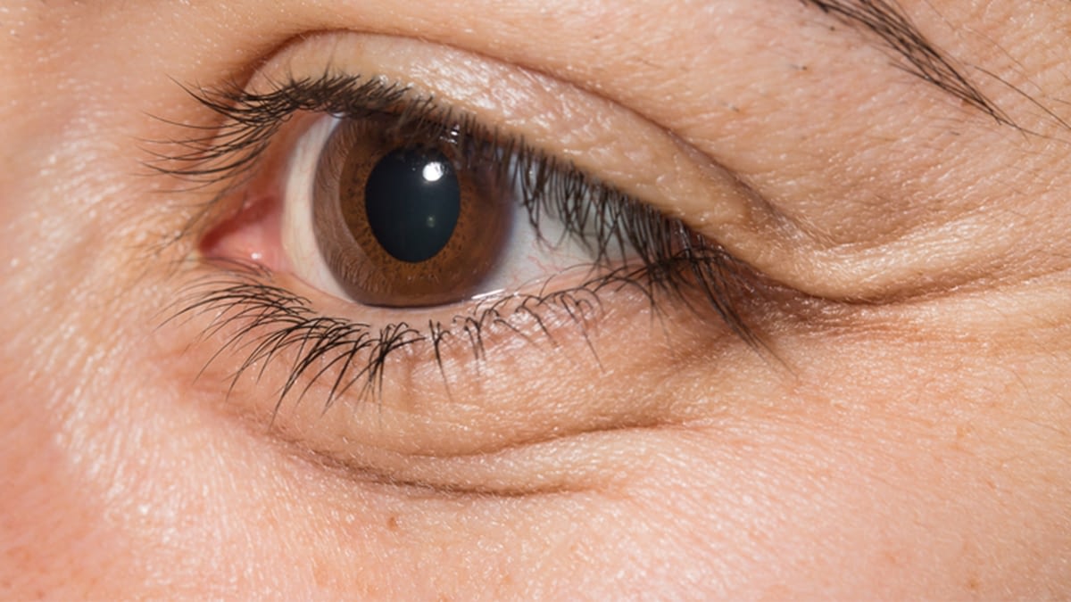 What Are The Possible Causes Of Swollen Eyes Dark Circles Free