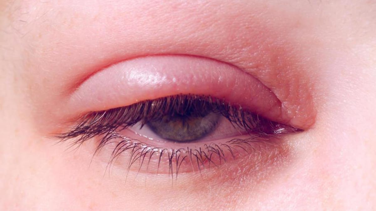 What Does A Swollen Upper Eyelid Mean