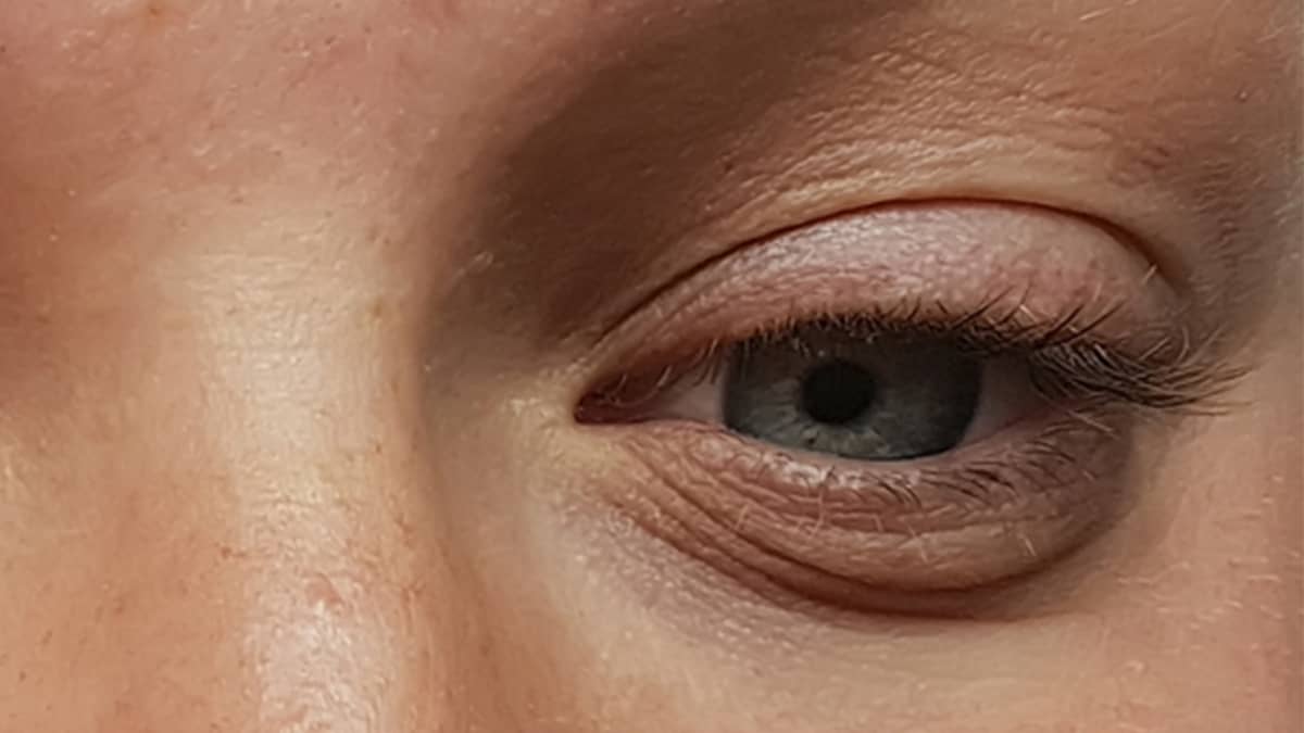 Are Eye Bags Permanent?