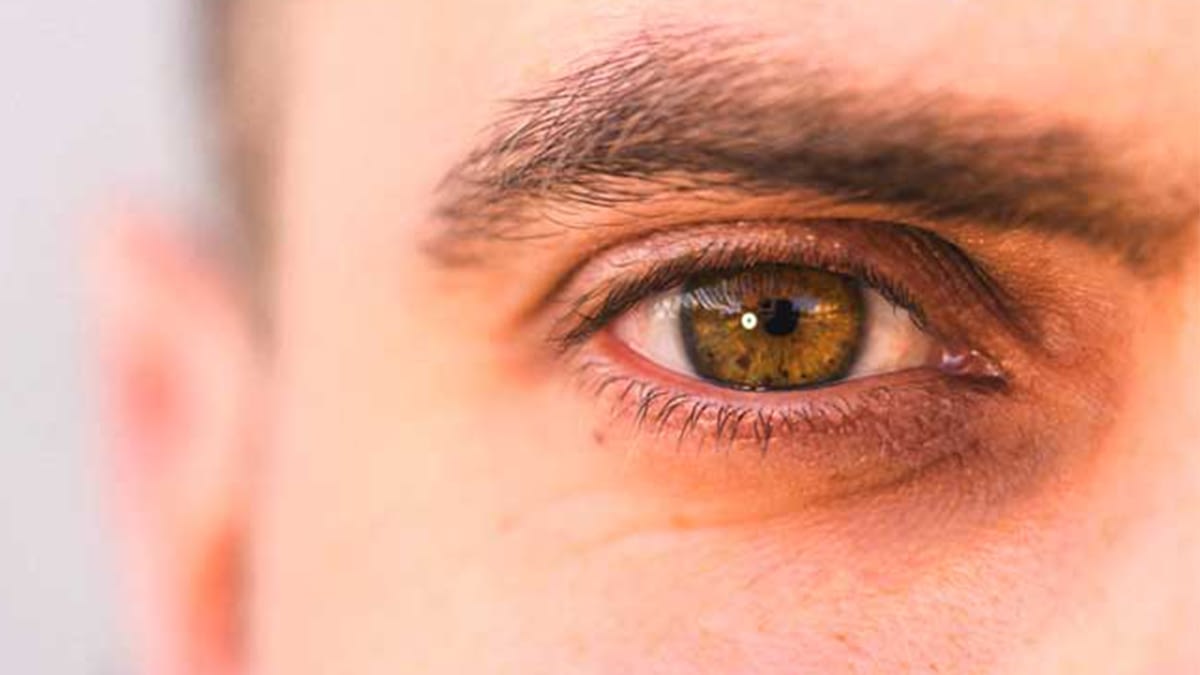 What Causes Redness And Dryness Around The Eyes