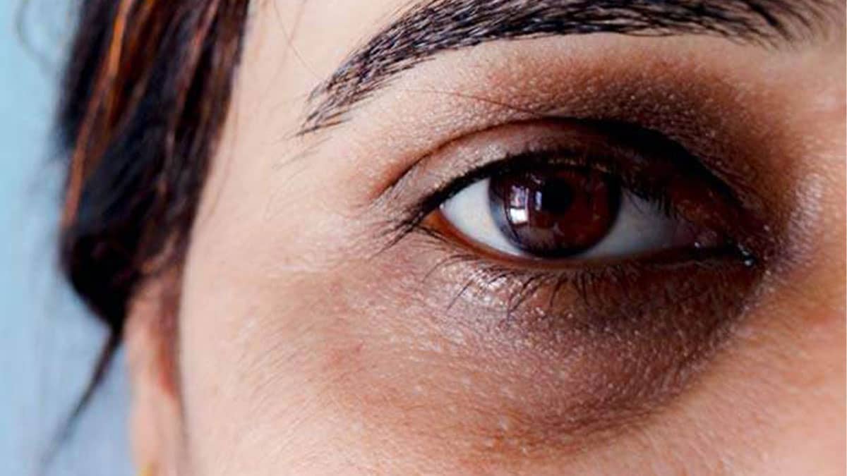 Best Treatment For Dark Circles Under The Eyes