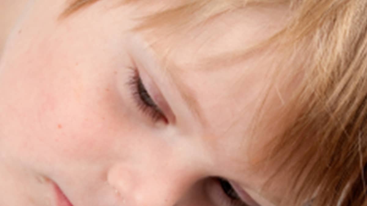 Remove-Dark-Circles-In-Kids Remove Dark Circles In Kids