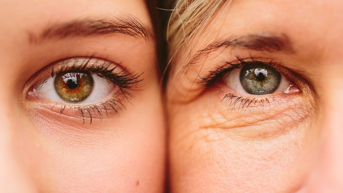 wrinkles under eyes at 20