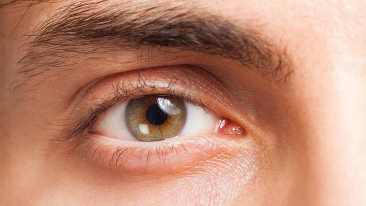 Reduce Dark Under-eye Circles