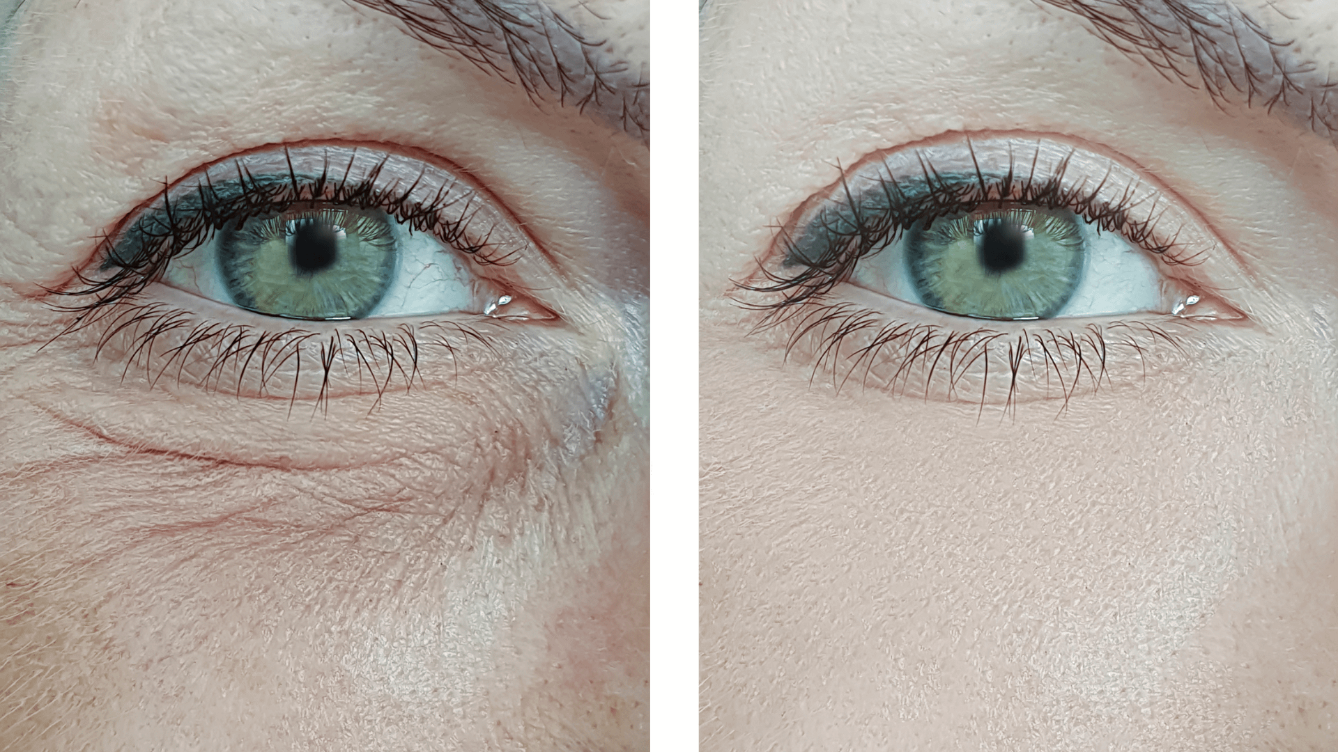 Eye Wrinkles Removal: Can You Remove It Naturally Eye Wrinkles Removal