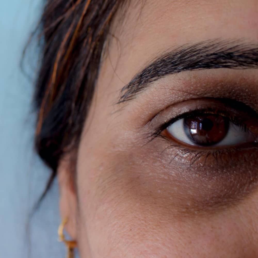 Dark-Circles What Are Allergic Shiners